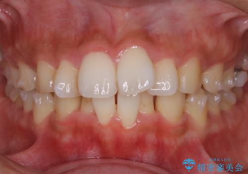 【非抜歯】インビザラインでガタつきと口元を改善!非抜歯でも印象が変わる矯正治療の治療中