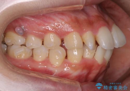 【非抜歯】インビザラインでガタつきと口元を改善!非抜歯でも印象が変わる矯正治療の治療中