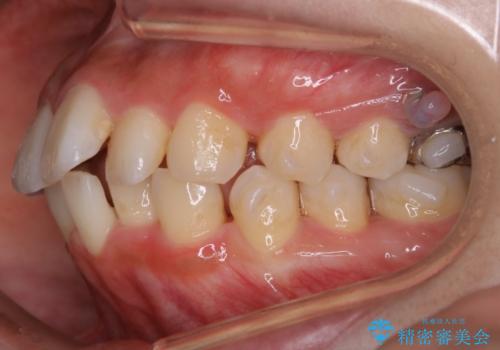 【非抜歯】インビザラインでガタつきと口元を改善!非抜歯でも印象が変わる矯正治療の治療中