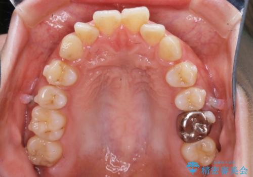 【非抜歯】インビザラインでガタつきと口元を改善!非抜歯でも印象が変わる矯正治療の治療中