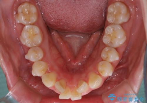 【非抜歯】インビザラインでガタつきと口元を改善!非抜歯でも印象が変わる矯正治療の治療中