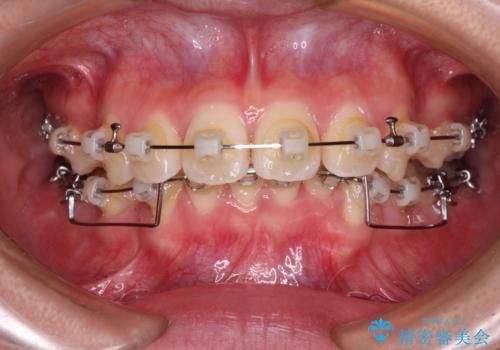 飛び出した上顎前歯 ワイヤー装置にて抜歯矯正治療の治療中
