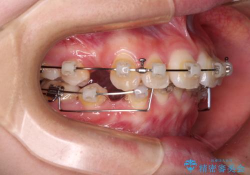 飛び出した上顎前歯 ワイヤー装置にて抜歯矯正治療の治療中