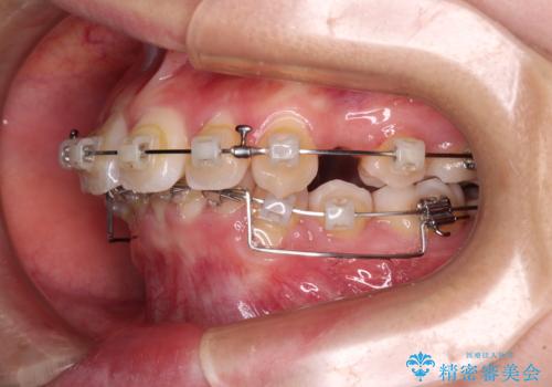 飛び出した上顎前歯 ワイヤー装置にて抜歯矯正治療の治療中
