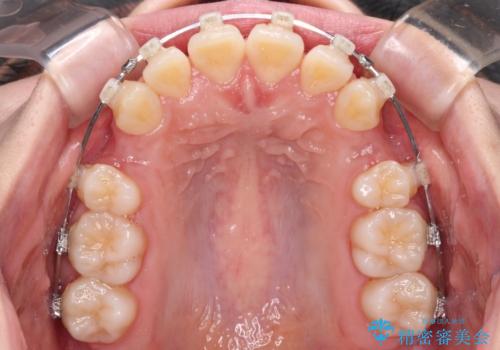 飛び出した上顎前歯 ワイヤー装置にて抜歯矯正治療の治療中