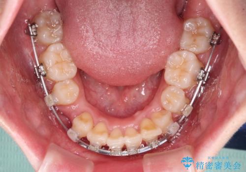 飛び出した上顎前歯 ワイヤー装置にて抜歯矯正治療の治療中