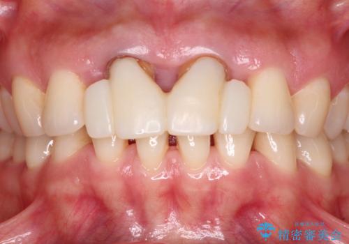 隙間をセラミックで閉じたら不格好で歯肉から出血 矯正治療と歯周外科で綺麗な前歯にの治療中