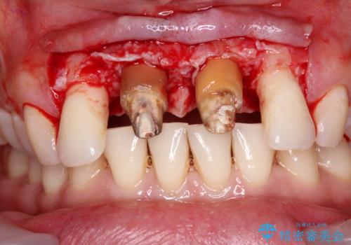 隙間をセラミックで閉じたら不格好で歯肉から出血 矯正治療と歯周外科で綺麗な前歯にの治療中
