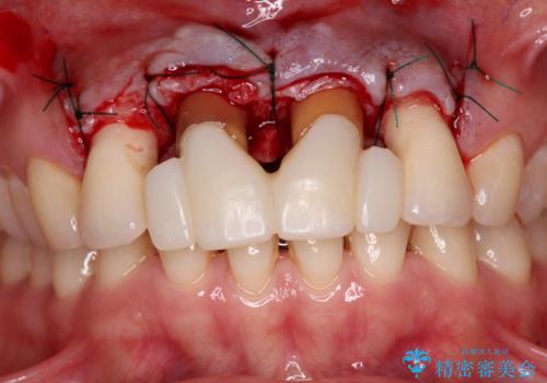 隙間をセラミックで閉じたら不格好で歯肉から出血 矯正治療と歯周外科で綺麗な前歯にの治療後