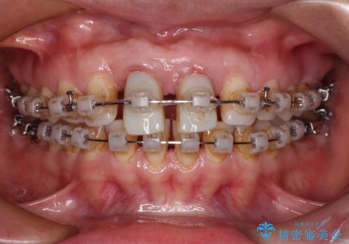 隙間をセラミックで閉じたら不格好で歯肉から出血 矯正治療と歯周外科で綺麗な前歯にの治療中