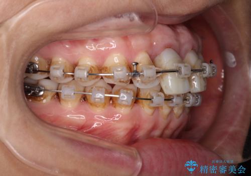隙間をセラミックで閉じたら不格好で歯肉から出血 矯正治療と歯周外科で綺麗な前歯にの治療中