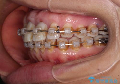 隙間をセラミックで閉じたら不格好で歯肉から出血 矯正治療と歯周外科で綺麗な前歯にの治療中