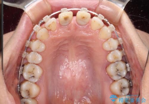 隙間をセラミックで閉じたら不格好で歯肉から出血　矯正治療と歯周外科で綺麗な前歯にの治療中