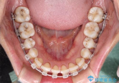 隙間をセラミックで閉じたら不格好で歯肉から出血 矯正治療と歯周外科で綺麗な前歯にの治療中