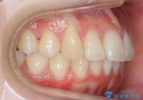 歯を抜かないで出っ歯を治したいの治療後