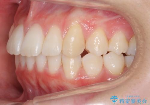 歯を抜かないで出っ歯を治したいの治療後