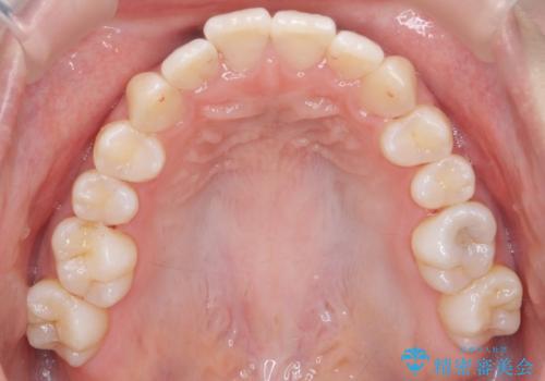 歯を抜かないで出っ歯を治したいの治療後