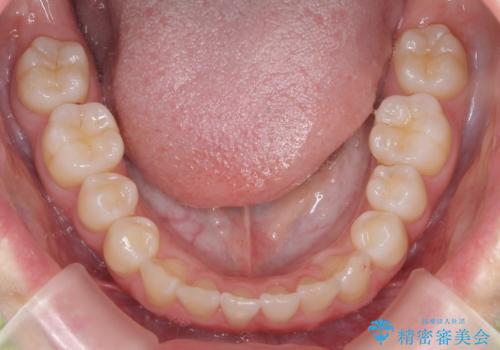 歯を抜かないで出っ歯を治したいの治療後