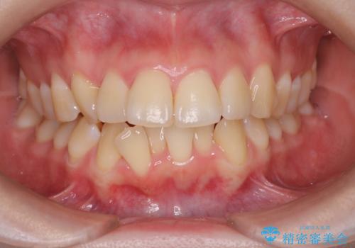 【インビザライン】抜歯矯正で口元も改善の治療前