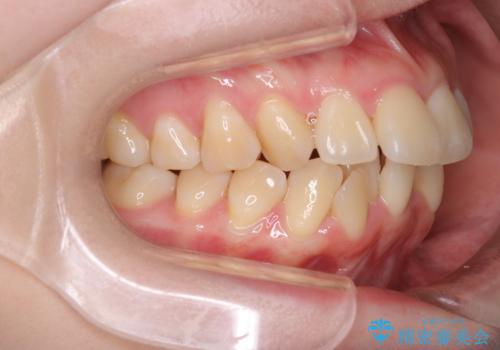 【インビザライン】抜歯矯正で口元も改善の治療前