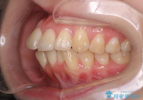 【インビザライン】抜歯矯正で口元も改善の治療前