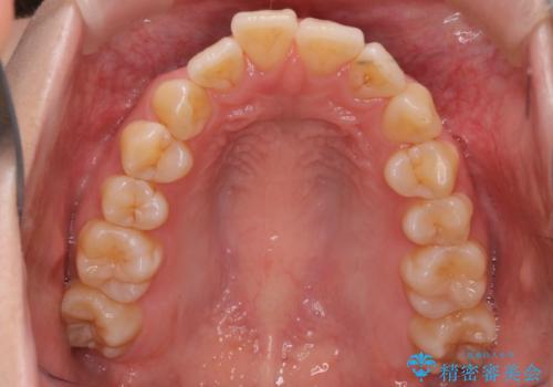 【インビザライン】抜歯矯正で口元も改善の治療前