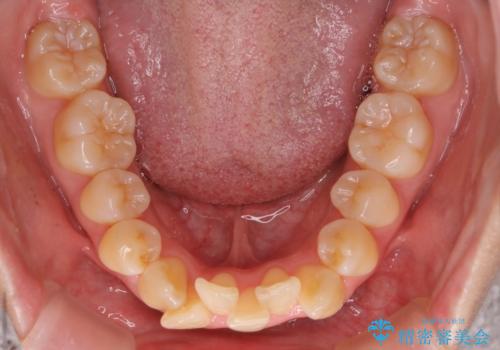 【インビザライン】抜歯矯正で口元も改善の治療前