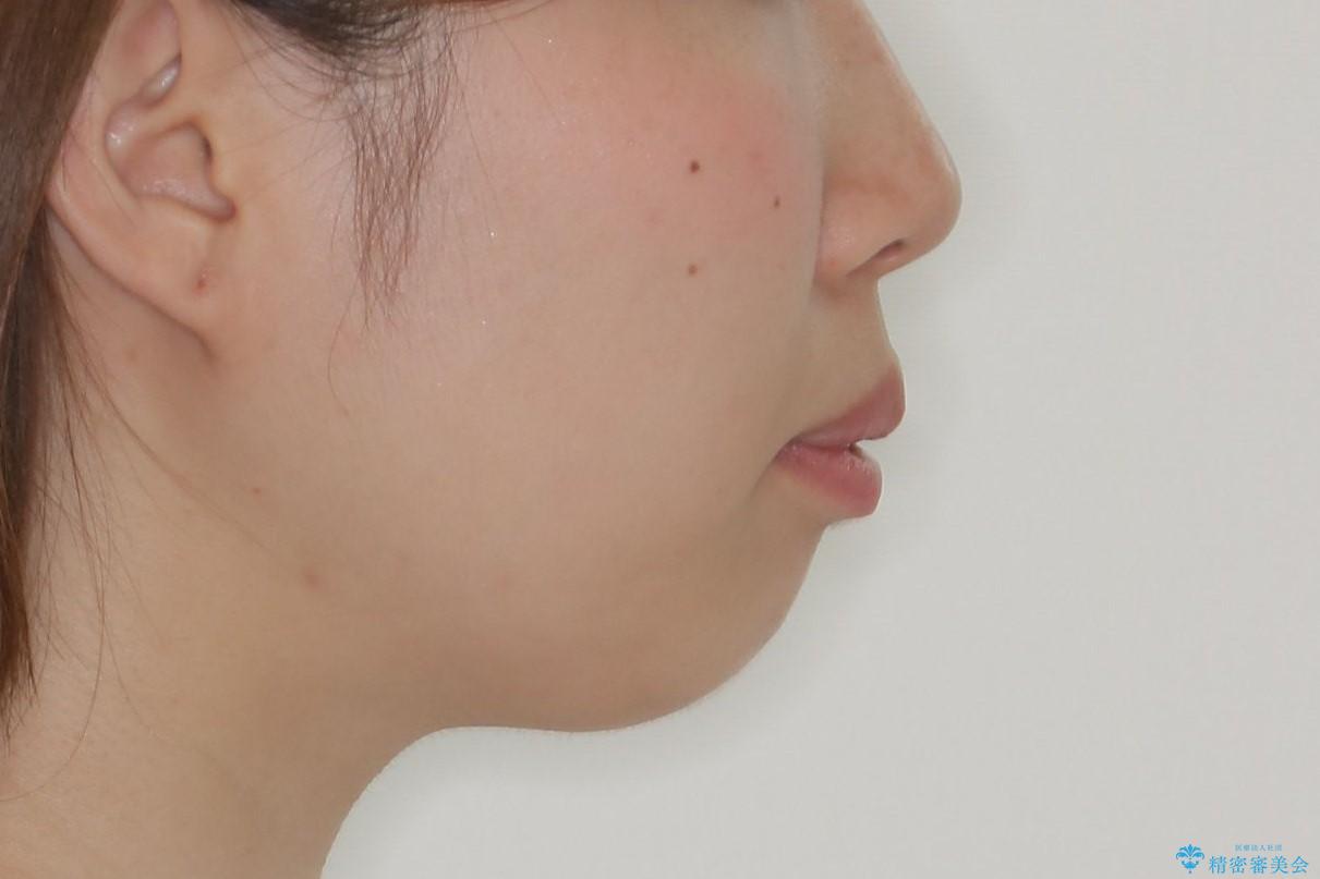 【インビザライン】抜歯矯正で口元も改善の治療前(顔貌)