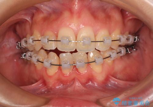 後戻りの再矯正 ワイヤー装置でデコボコと隙間を改善の治療中