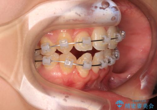 後戻りの再矯正 ワイヤー装置でデコボコと隙間を改善の治療中