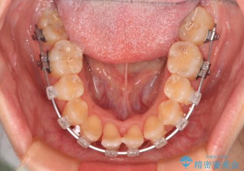 後戻りの再矯正 ワイヤー装置でデコボコと隙間を改善の治療中