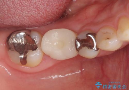 虫歯で失ってしまった奥歯、インプラント治療で再び噛めるように!の治療後