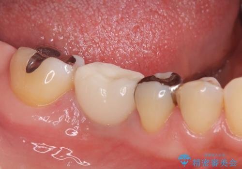 虫歯で失ってしまった奥歯、インプラント治療で再び噛めるように!の治療後