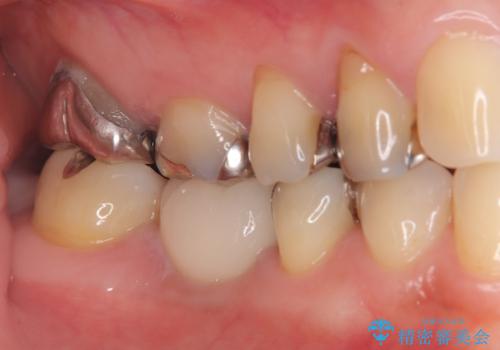 虫歯で失ってしまった奥歯、インプラント治療で再び噛めるように!の治療後
