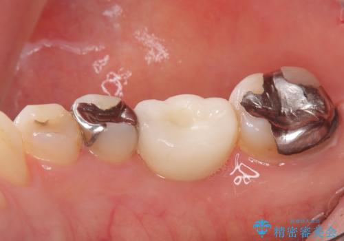 虫歯で失ってしまった奥歯、インプラント治療で再び噛めるように!の治療後