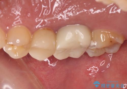 不快感の強い奥歯 オールセラミッククラウンでのむし歯治療の治療前