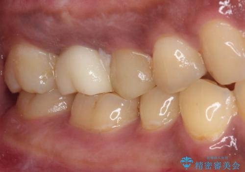 不快感の強い奥歯 オールセラミッククラウンでのむし歯治療の治療前