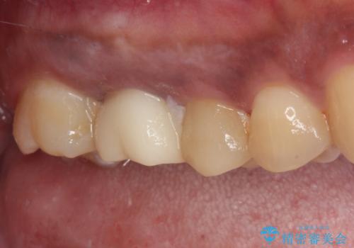 不快感の強い奥歯 オールセラミッククラウンでのむし歯治療の治療前