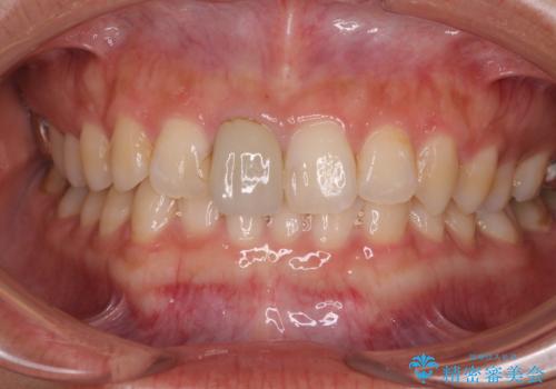 不自然な前歯の被せものをやり替えたいの症例 治療前