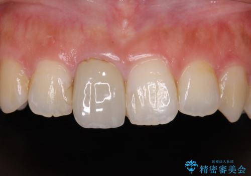 不自然な前歯の被せものをやり替えたいの治療前