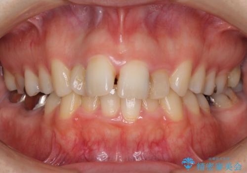 飛び出した上顎前歯とむし歯の多い歯列　目立たないハーフリンガル矯正とむし歯治療の治療前