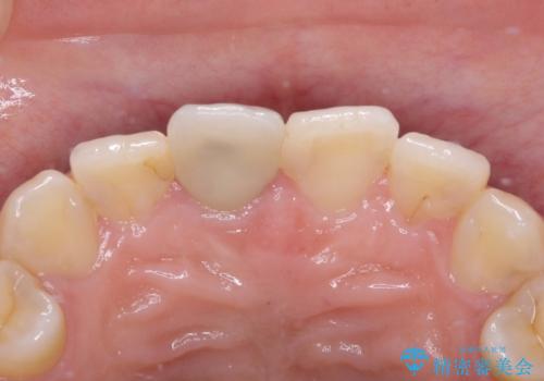 不自然な前歯の被せものをやり替えたいの治療前