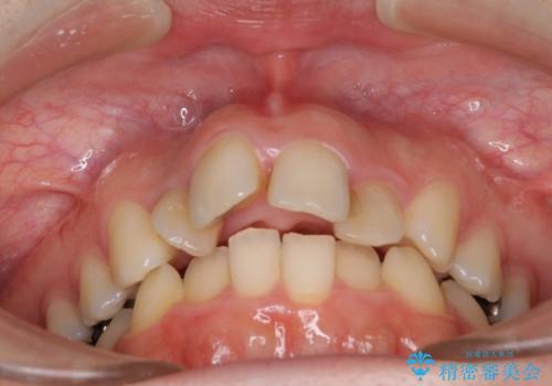 飛び出した上顎前歯とむし歯の多い歯列 目立たないハーフリンガル矯正とむし歯治療の治療前