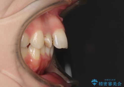 飛び出した上顎前歯とむし歯の多い歯列 目立たないハーフリンガル矯正とむし歯治療の治療前
