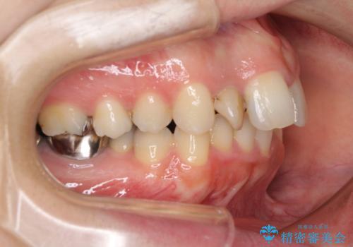 飛び出した上顎前歯とむし歯の多い歯列 目立たないハーフリンガル矯正とむし歯治療の治療前