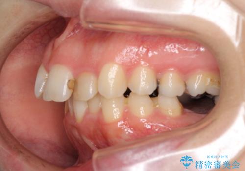 飛び出した上顎前歯とむし歯の多い歯列　目立たないハーフリンガル矯正とむし歯治療の治療前