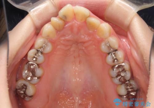 飛び出した上顎前歯とむし歯の多い歯列 目立たないハーフリンガル矯正とむし歯治療の治療前