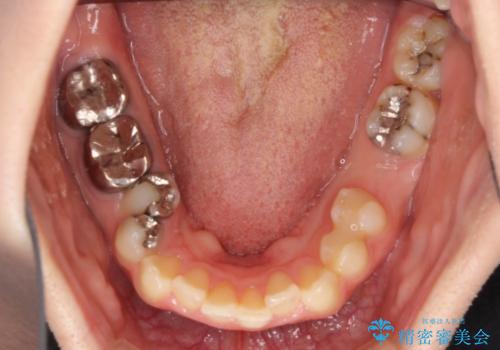 飛び出した上顎前歯とむし歯の多い歯列 目立たないハーフリンガル矯正とむし歯治療の治療前