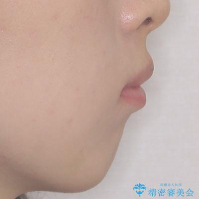 飛び出した上顎前歯とむし歯の多い歯列 目立たないハーフリンガル矯正とむし歯治療の治療前(顔貌)