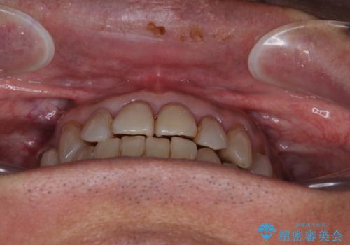今からでも綺麗な歯並びを手に入れたい 40代男性のワイヤー矯正の治療後